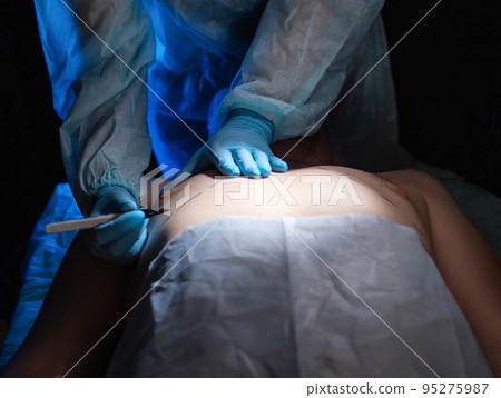Plastic surgeon doctor prepares for breast reduction surgery on a man, close-up. Liposuction 95275987