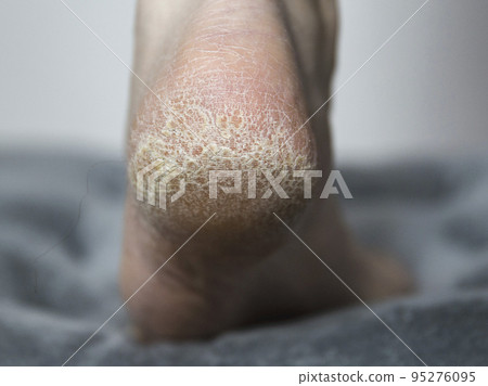 dry skin with cracks on the heel of the foot in a person, close-up. Treatment of hardened and cracked skin, dermatology 95276095