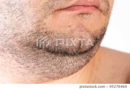 The face of an overweight man. Fat double chin. Aesthetic defect. double chin correction, close-up The face of an overweight man. Fat double chin. Aesthetic defect. double chin correction, close-up 95276469