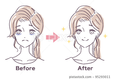 黑眼圈治療前後 患有黑眼圈的女人 失眠 睡眠不足 人物插圖素材 95293011