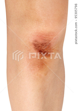 腿膝蓋受傷,結痂 腿膝蓋受傷,結痂 95305798