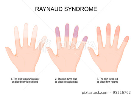 hands of a person with Raynaud's phenomenon from white color when blood flow is restricted to blue and red when blood flow returns 95316762