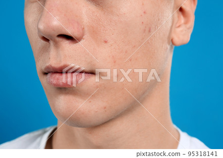Teen guy with acne problem on blue background, closeup Teen guy with acne problem on blue background, closeup 95318141