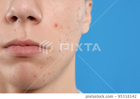 Teen guy with acne problem on blue background, closeup 95318142