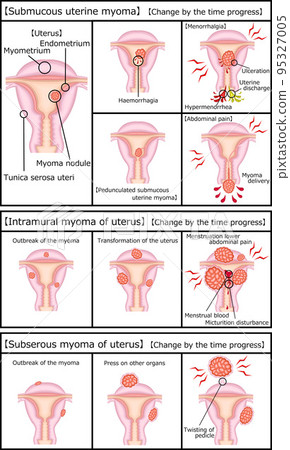 Types and progress of uterine fibroids Illustration English Types and progress of uterine fibroids Illustration English 95327005