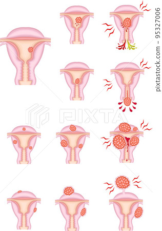 Types and progress of uterine fibroids illustration 95327006