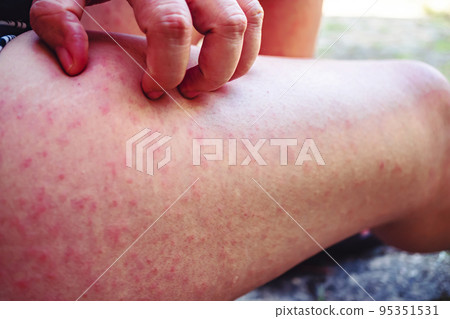Itching of the wound on the thigh, A young woman scratching her legs with one hand due to itching, A woman scratching her thigh because of a rash. Itching of the wound on the thigh, A young woman scratching her legs with one hand due to itching, A woman scratching her thigh because of a rash. 95351531