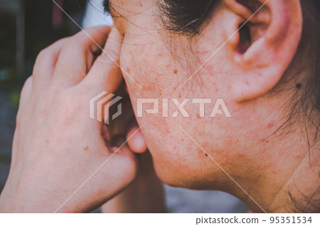 Women who have problems and stress issues., Women with skin problems and acne scars Women who have problems and stress issues., Women with skin problems and acne scars 95351534