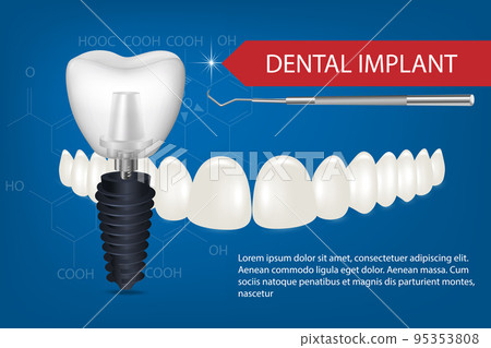 Realistic white dental implant on a blue background with beautiful teeth mockup. Vector 3d model of an implant with thread and inscription. 95353808