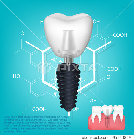 Vector realistic tooth. Structural elements of a dental implant. Infographic for medical poster. Vector realistic tooth. Structural elements of a dental implant. Infographic for medical poster. 95353809