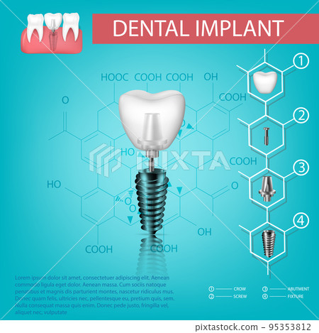 Vector realistic tooth. Structural elements of a dental implant. Infographic for medical poster. 95353812
