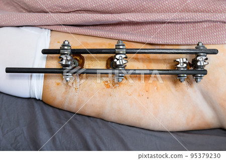 top view of external fixation device in patient top view of external fixation device in patient 95379230