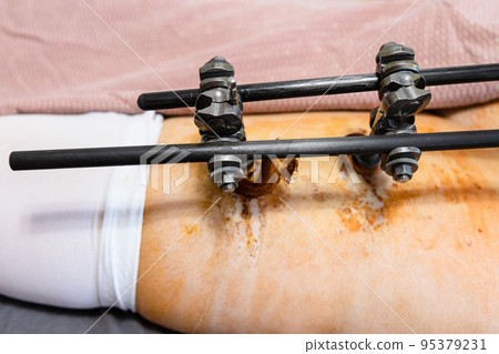 external fixation device on hip with bone fracture external fixation device on hip with bone fracture 95379231
