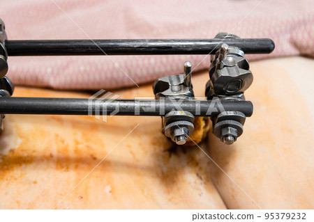 external fixation device on pelvic close up external fixation device on pelvic close up 95379232