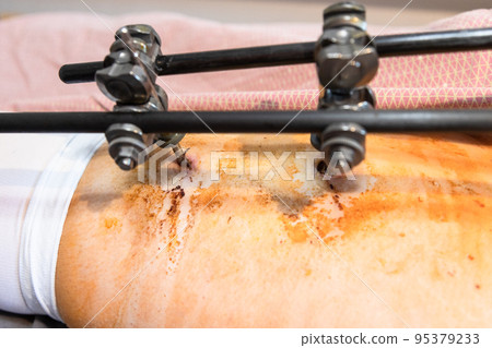 hole in skin from external fixation device on hip hole in skin from external fixation device on hip 95379233
