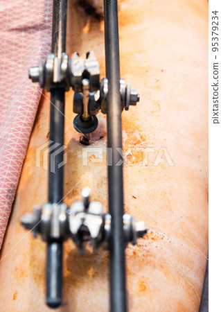 wound in skin from external fixation device on hip wound in skin from external fixation device on hip 95379234