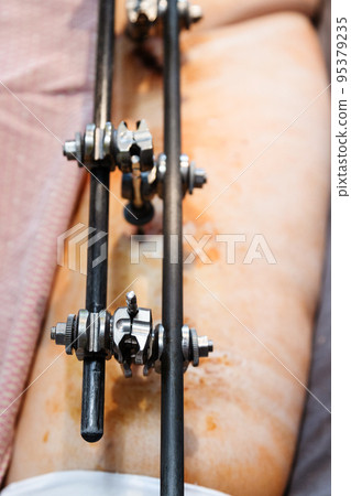 metal external fixation device on hip and pelvic metal external fixation device on hip and pelvic 95379235
