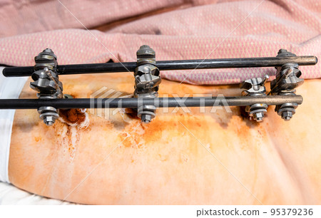 above view of external fixation device on hip above view of external fixation device on hip 95379236