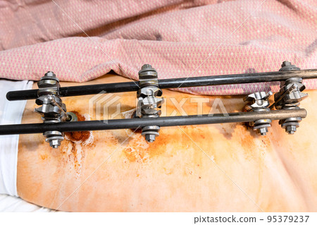 view of external fixation device on hip and pelvic view of external fixation device on hip and pelvic 95379237