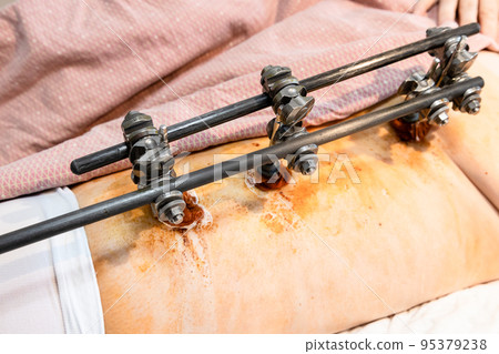 external fixation device on hip and pelvic external fixation device on hip and pelvic 95379238