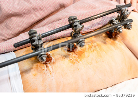 wounds around rods of external fixation device wounds around rods of external fixation device 95379239