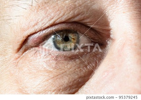 male eye with thickening on eyelid from chalazion male eye with thickening on eyelid from chalazion 95379245