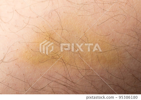 Wound on human skin Wound on human skin 95386180