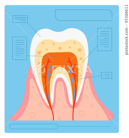 Tooth anatomy medical poster. Dental structure infographic Tooth anatomy medical poster. Dental structure infographic 95386611