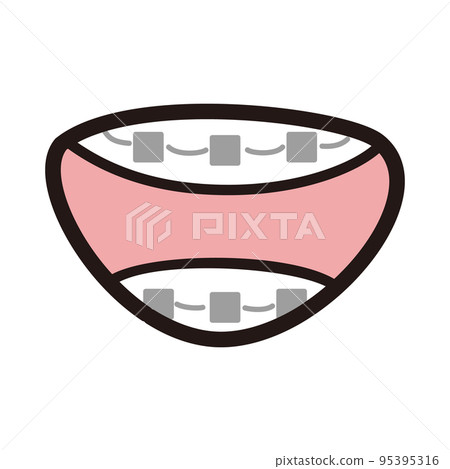 Illustration of teeth with braces 95395316