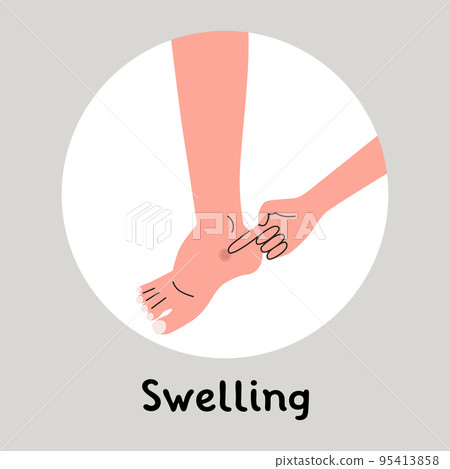 Swelling of the feet, edema. By pressing a finger a dent appers. Flat vector illustration 95413858