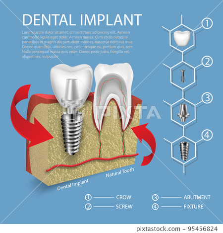 Human teeth and dental implant vector in gum mockup. 95456824
