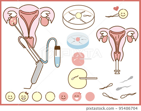 Illustration of fertility treatment, microscopic insemination, in vitro fertilization, artificial insemination 95486704
