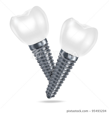 Vector 3d realistic rendering of white dental implant dentures closeup isolated on white background. Dentistry, medicine and healthcare concept. Prosthesis design template. Foreground. Vector 3d realistic rendering of white dental implant dentures closeup isolated on white background. Dentistry, medicine and healthcare concept. Prosthesis design template. Foreground. 95493204