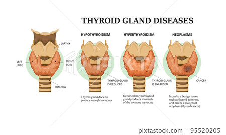 Thyroid gland diseases - hyperthyroidism, hypothyroidism and neoplasms Thyroid gland diseases - hyperthyroidism, hypothyroidism and neoplasms 95520205