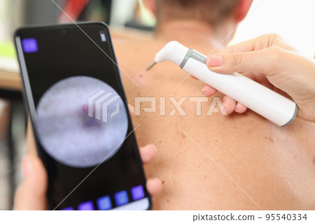 Man removes pigmentation on back in cosmetic clinic 95540334