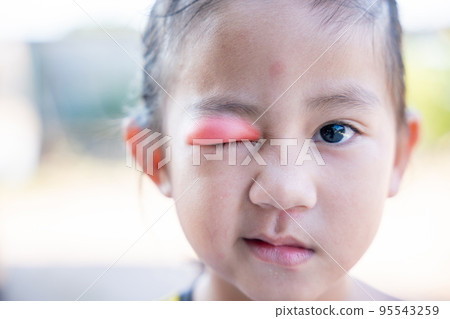 Closed Asian kid little girl eye with sty Closed Asian kid little girl eye with sty 95543259