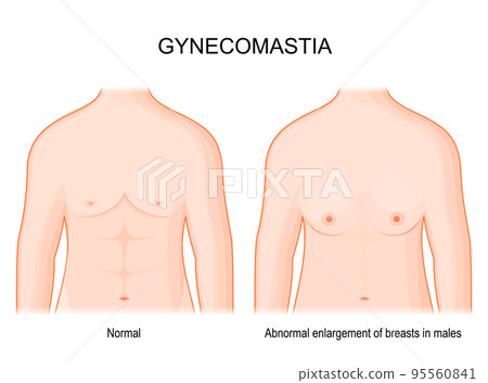 Gynecomastia. Human chest in front view. hormone imbalance 95560841