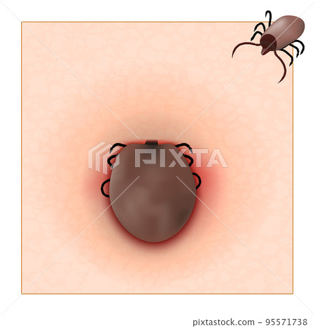 Tick before and after feeding. Tick-borne encephalitis 95571738