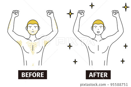 Image of medical hair removal, before and after a man who is worried about having thick body hair loses hair and becomes smooth 95588751