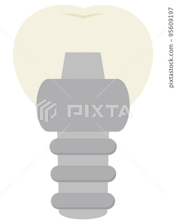 Implant Implant 95609197