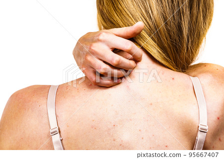 Woman with skin problem acne on back 95667407