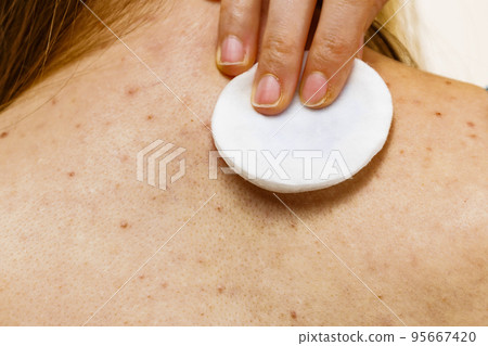 Woman acne on back cleaning skin with tonic 95667420
