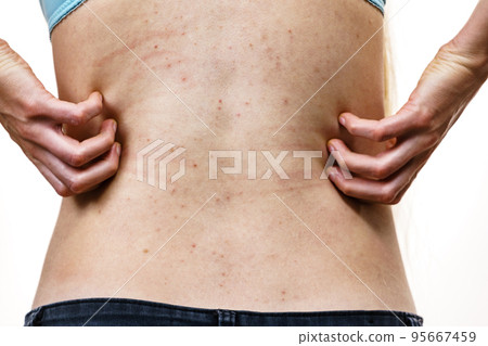 Woman scratching her itchy back with allergy rash Woman scratching her itchy back with allergy rash 95667459