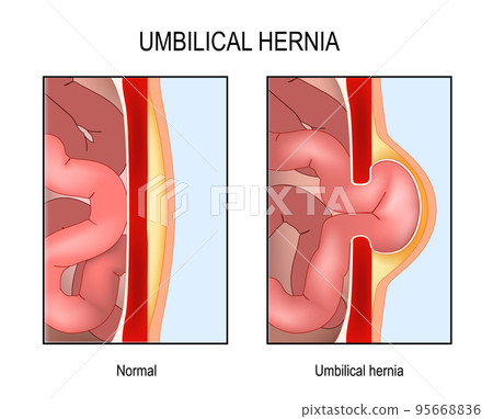 Umbilical hernia. Cross section of abdomen with small intestine 95668836