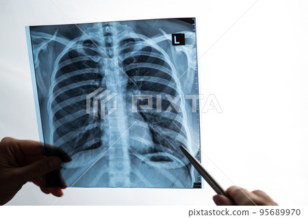 Doctor showing x-ray of patient's lungs.  95689970