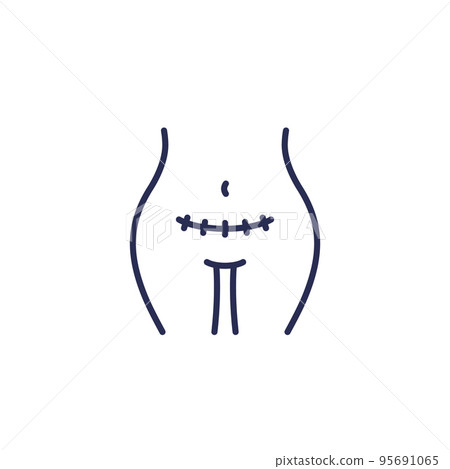 cesarean section, scar line icon 95691065