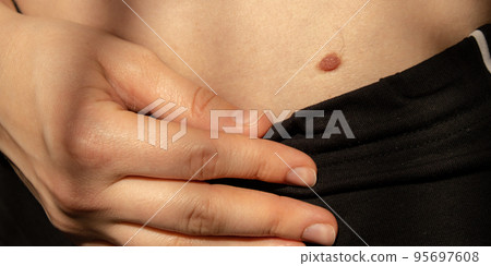 Birthmarks on skin Close up detail of the bare skin Sun Exposure effect on skin, Health Effects of UV Radiation Woman with birthmarks Pigmentation and lot of birthmarks. Birthmarks on skin Close up detail of the bare skin Sun Exposure effect on skin, Health Effects of UV Radiation Woman with birthmarks Pigmentation and lot of birthmarks. 95697608