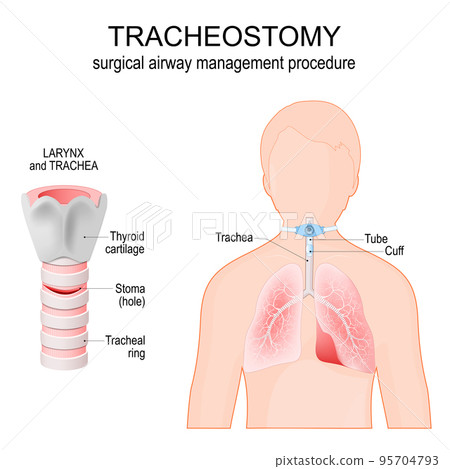 Tracheostomy. Anatomy of the trachea with stoma. larynx. 95704793