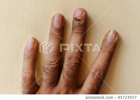 Fungus Infection on Nails Hand, Finger with onychomycosis. 95724557