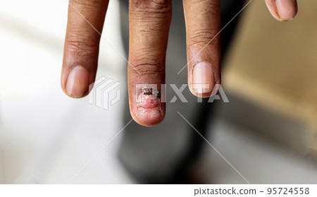 Fungus Infection on Nails Hand, Finger with onychomycosis. 95724558